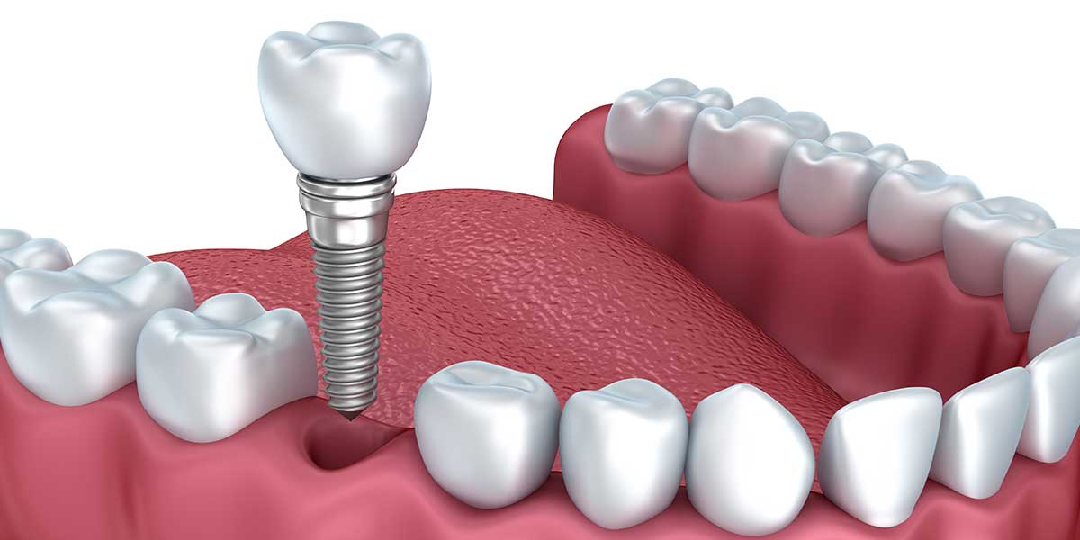 dental implants