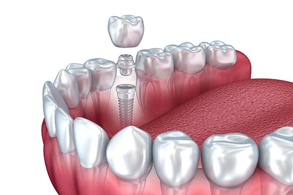 Dental implant illustration