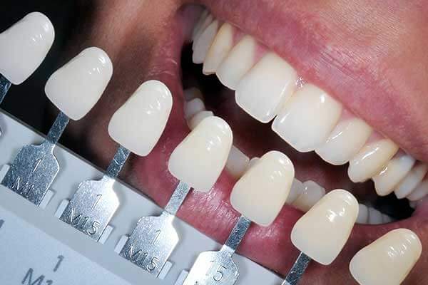 What Is Composite Filling? A Guide